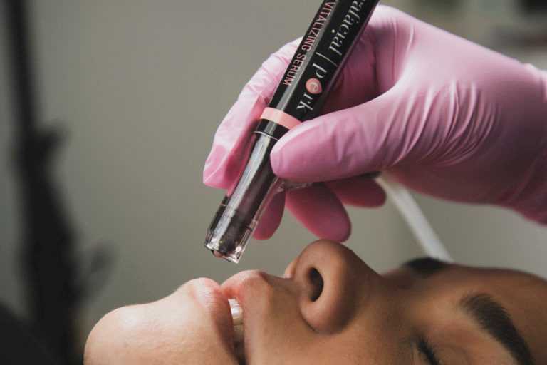 Close-up of a person receiving a facial treatment with a serum-infused microneedling device.