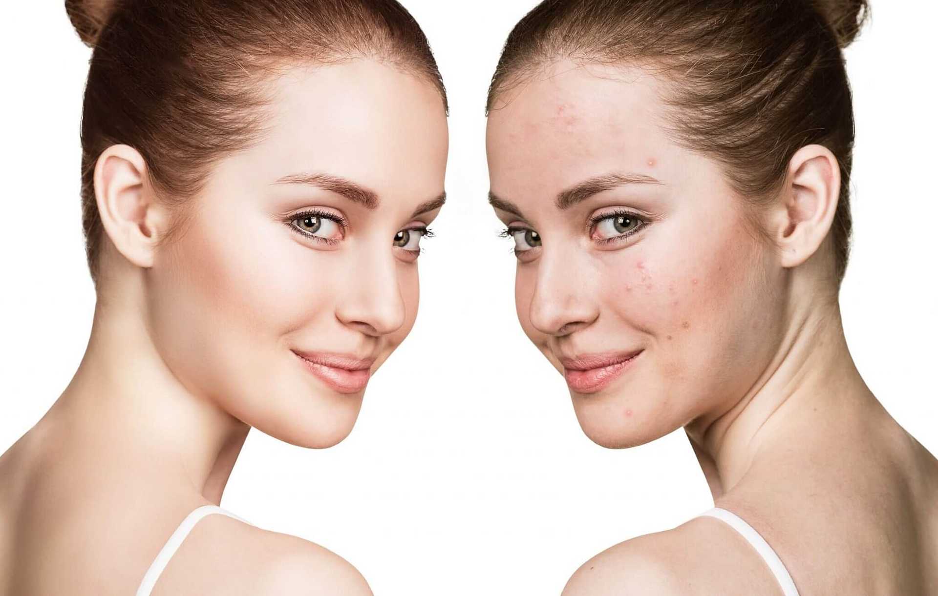 Two women with similar features, one with clear skin and the other with acne, looking at the camera.