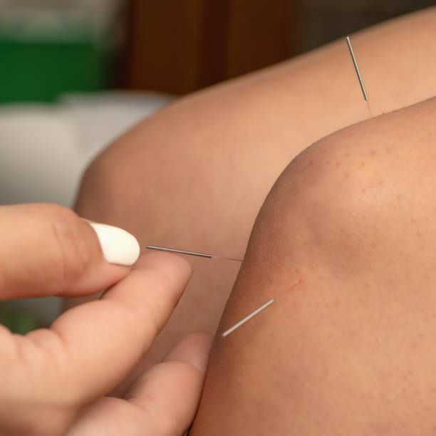 Acupuncture needles inserted in a person's knee for therapeutic treatment.