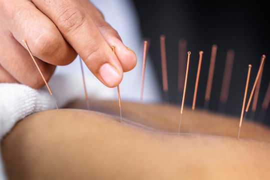 Acupuncture needles inserted into a person's skin, close-up view.