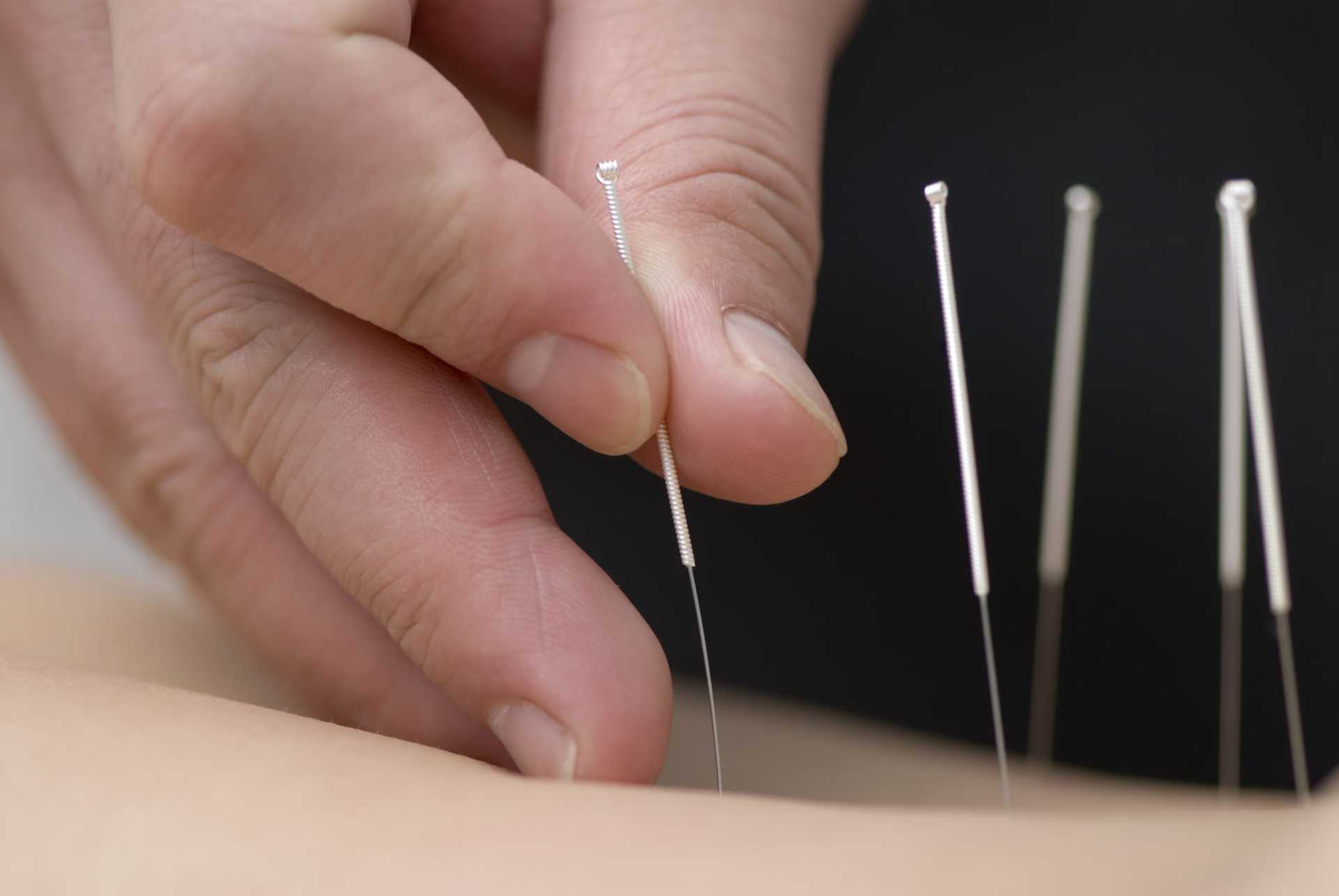 Acupuncture treatment with needles placed in skin, close-up of hands.